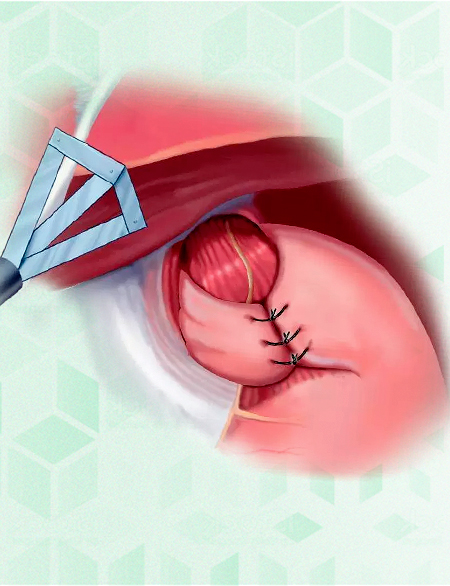 6 passos para recuperação após cirurgia de hérnia de hiato - SBH